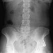 Abdomen X-ray