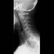 Cervical Spine X-ray