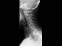 Cervical Spine X-ray