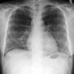 Chest X-ray