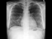 Chest X-ray