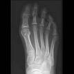 Foot X-ray