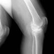 Knee X-ray