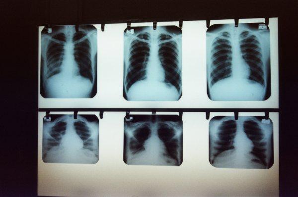 X-rays