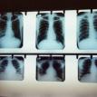 X-rays